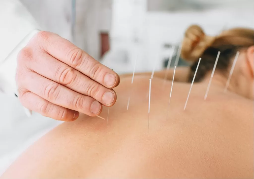 Fine acupuncture needles placed along a patient's upper back